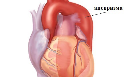 grud-prichiny-serdce-anevrisma