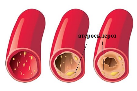 grud-prichiny-serdce-ateroskleros