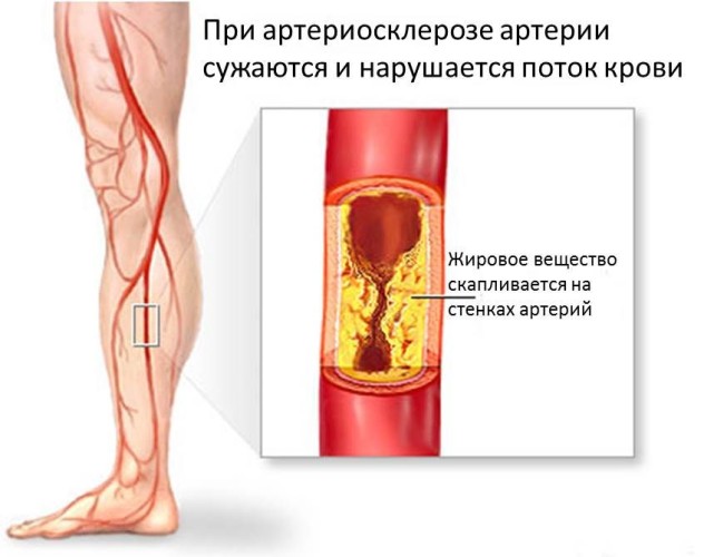 Артериальные нарушения в икрах