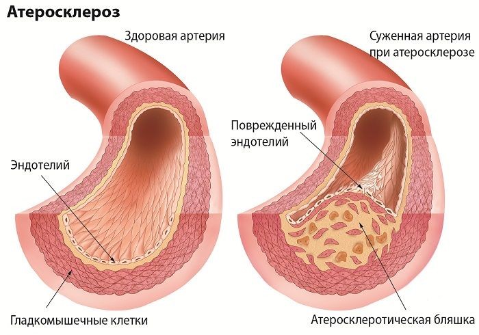 Атеросклероз ног