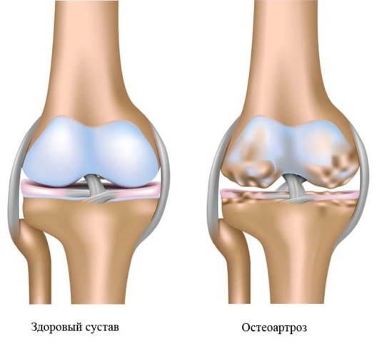 Деформация коленного сустава