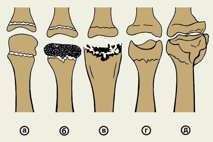 Дистрофический процесс бедренной кости