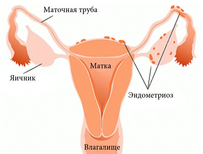 Эндометриоз