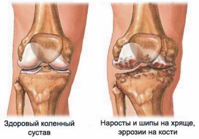 Гонартроз коленного сустава