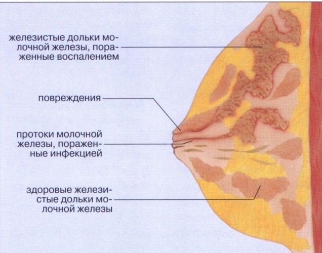 Мастит