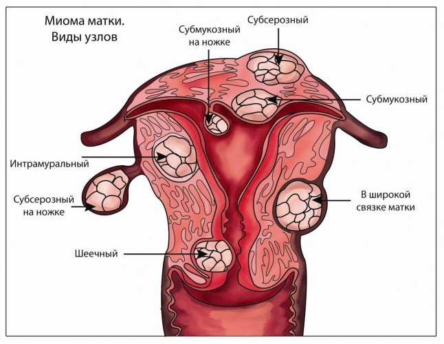 Миома матки