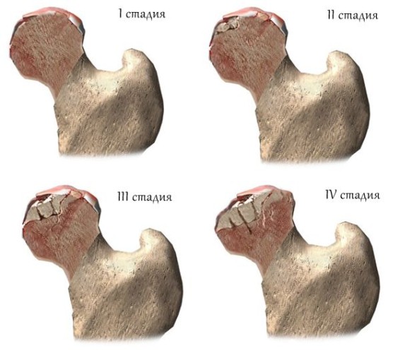 Некроз головки бедренной кости