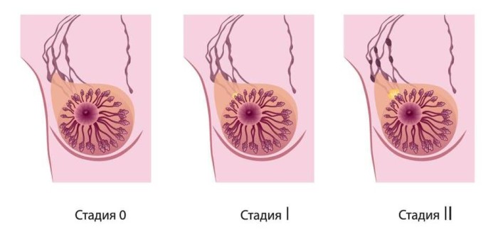 Опухоль молочной железы