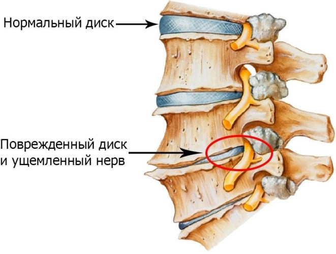 Остеохондроз поясницы