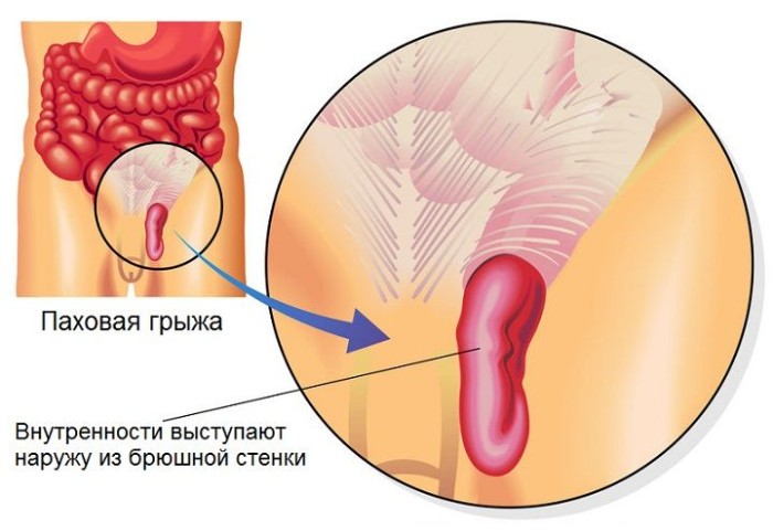 Паховая грыжа у ребенка