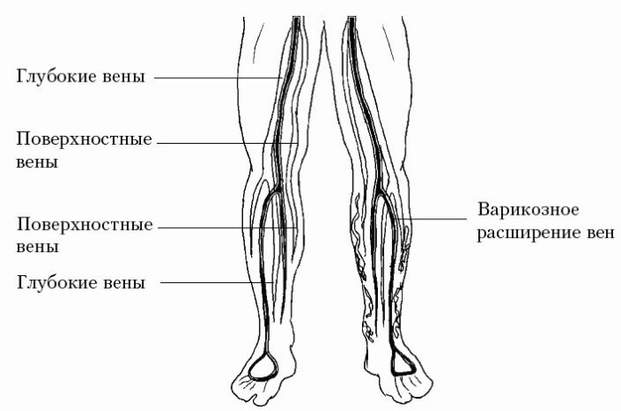 Патология венозных икр