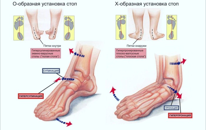 Плоскостопие