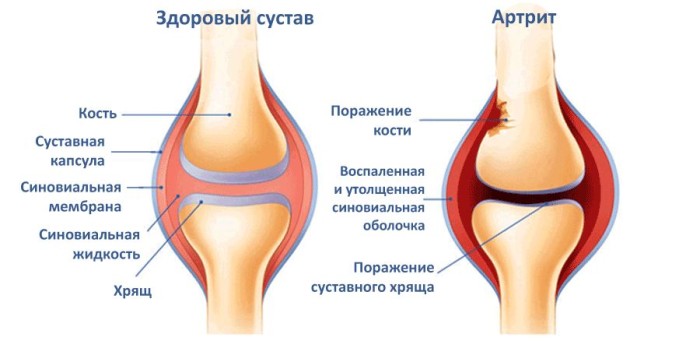 Подагра колена