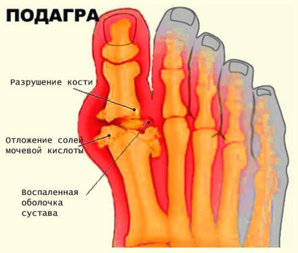 Подагра пальца ноги