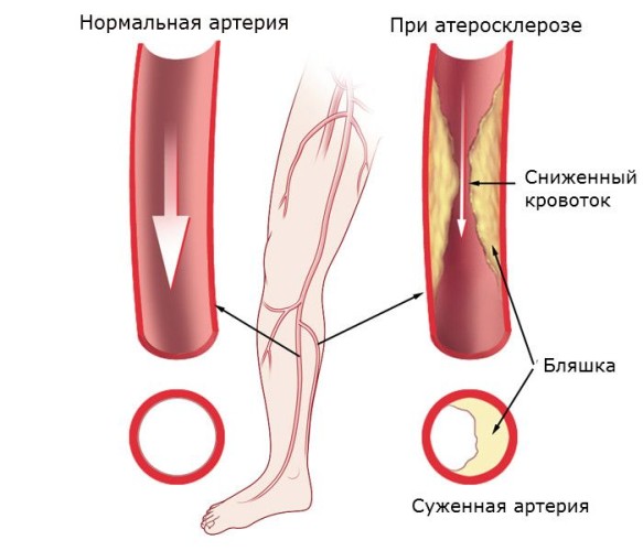 Поражение артерий ног