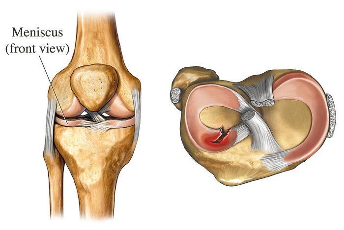 Повреждение менисков коленного сустава