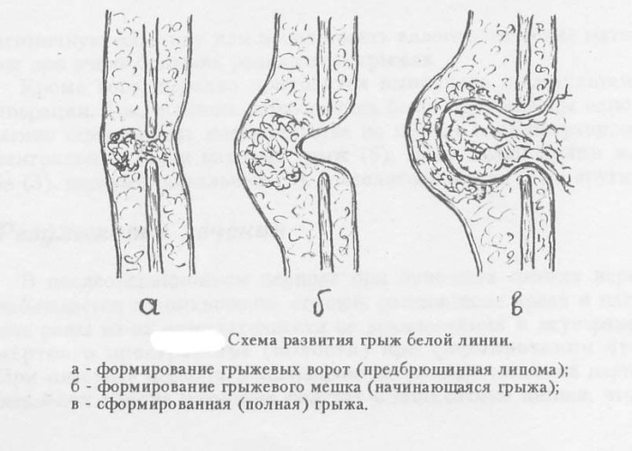 Пупочная грыжа у ребенка