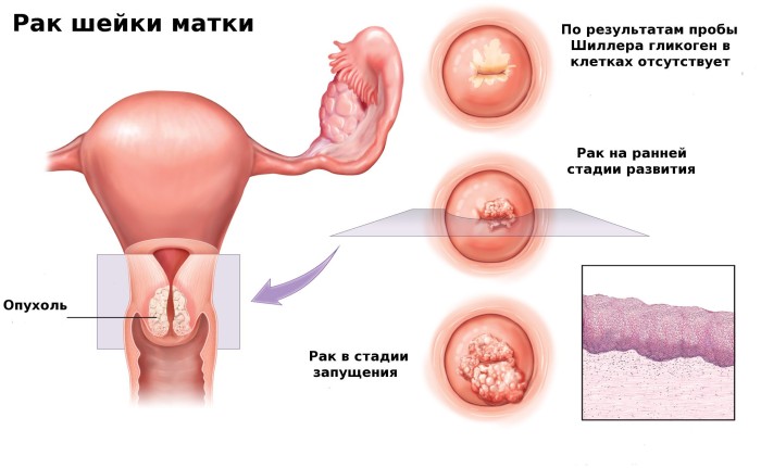 Рак матки