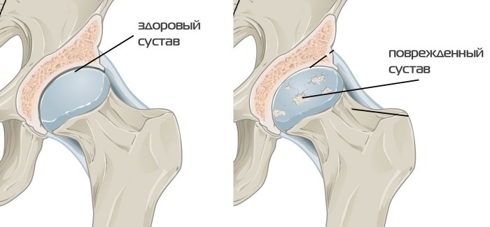 Разрушение хряща бедренного сустава