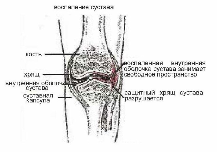 Разрушение хрящевой ткани сустава