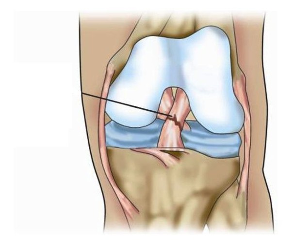 Разрыв связок коленного сустава