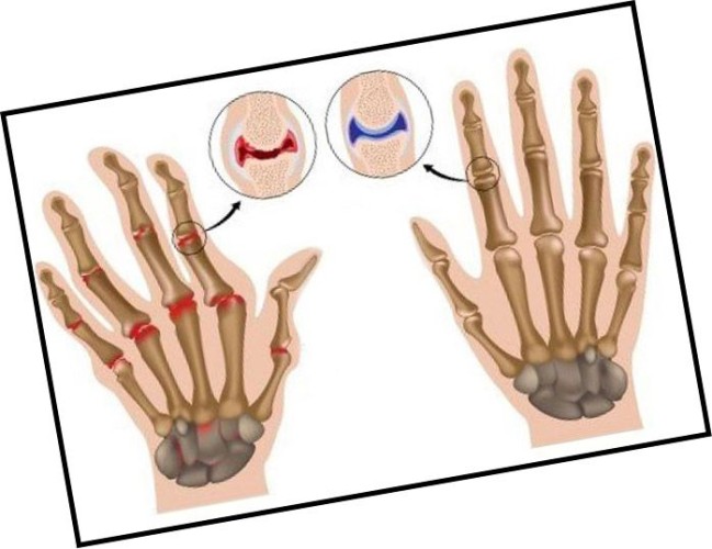 Ризартроз пальцев рук