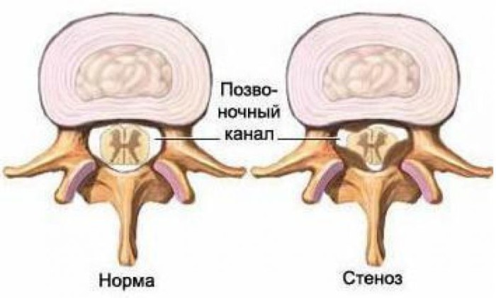 Сужение межпозвоночного канала