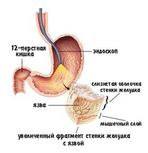 Заболевания желудка