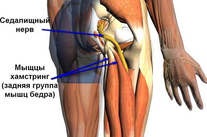 Защемление седалищной мышцы