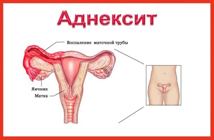 Аднексит