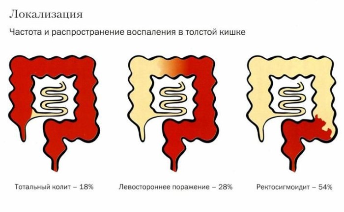 Боль сигмовидной кишки