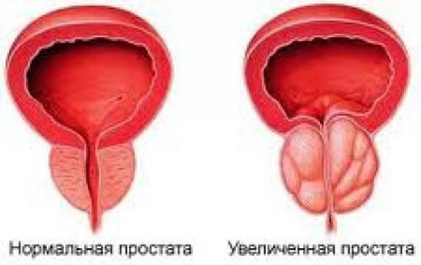 Хронический простатит