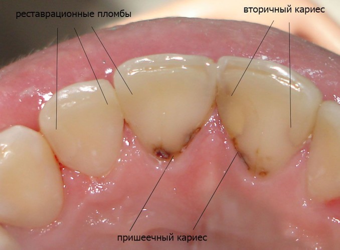 Кариес