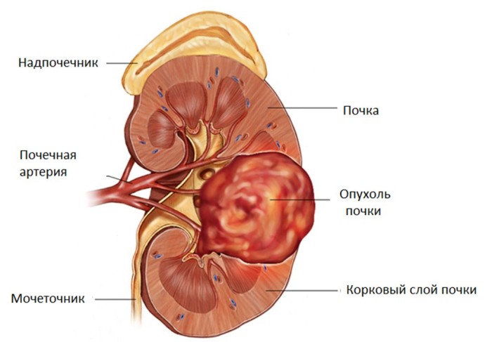 Патологии почек