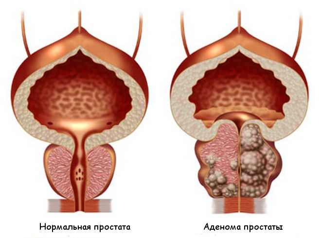 Простатит