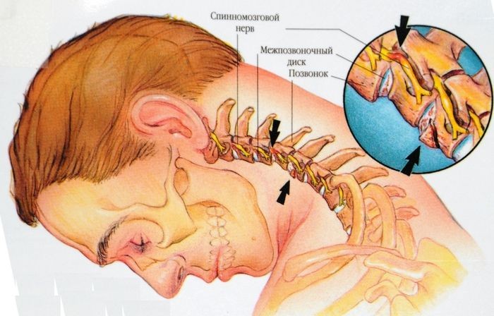 Остеохондроз шеи