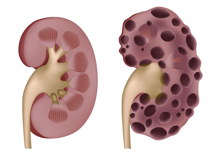 Поликистоз почек
