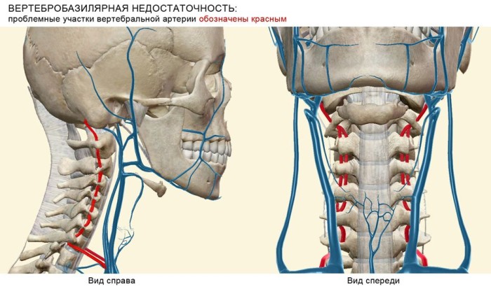 Вертебро-базилярная недостаточность