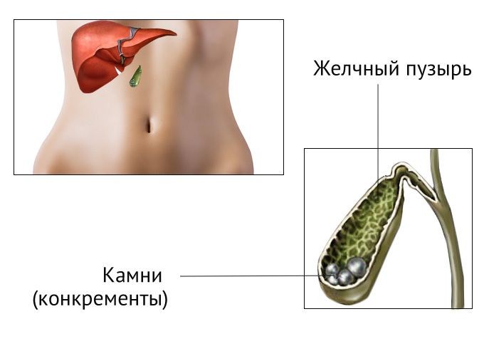 Желчнокаменная болезнь