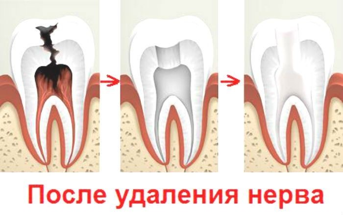 Зубной нерв