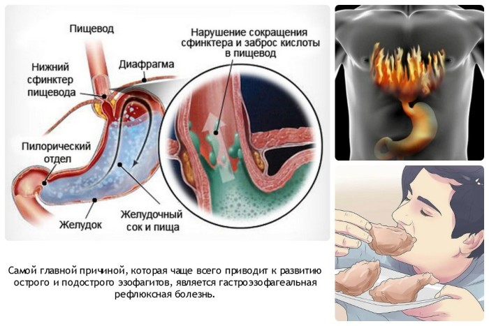 Гастроэзофагеальная рефлюксная болезнь