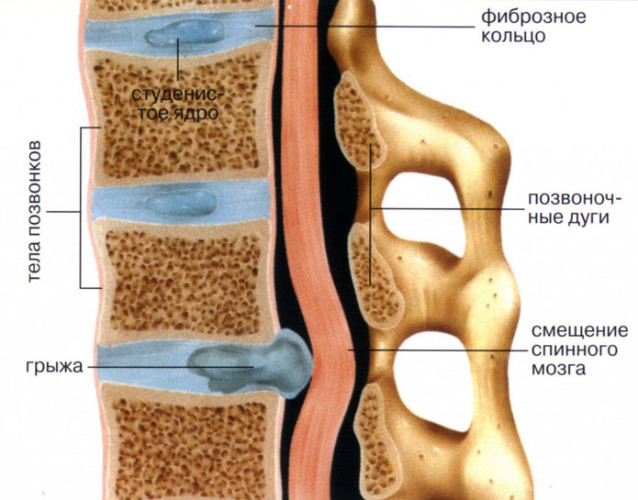 Межпозвоночная грыжа шейного отдела