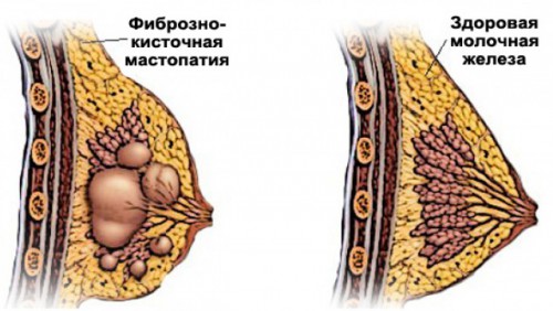 Мастопатия