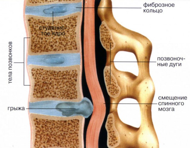 Межпозвоночная грыжа шея