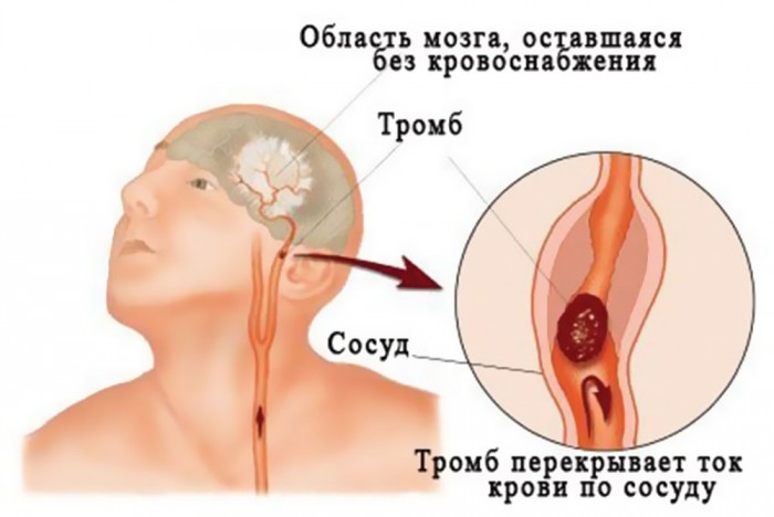 Нарушения кровообращения мозга