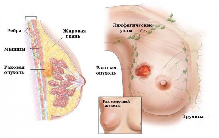 Рак молочной железы