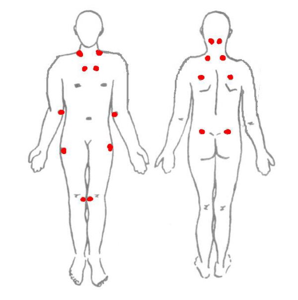 Фибромиалгия точки