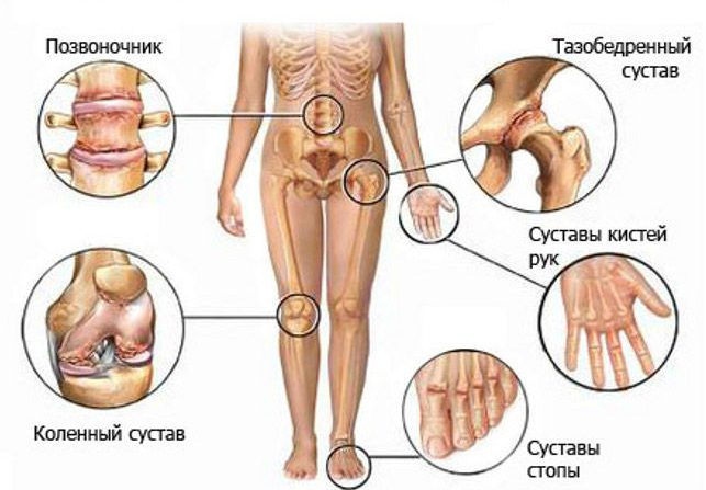 Болят все суставы тела