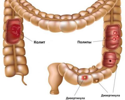 дивертикулит