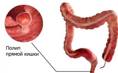 полип прямой кишки